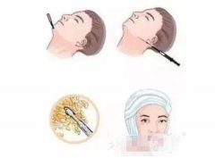 面部抽脂后皮膚會(huì)松弛嗎？果是*的嗎？