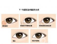 手術(shù)設(shè)計(jì)與開內(nèi)眼角的果有關(guān)系嗎？