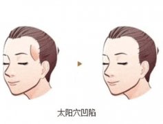 太陽(yáng)穴凹陷應(yīng)該怎么辦？太陽(yáng)穴凹陷有什么特點(diǎn)？