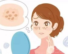 激光去痘印后如何處理抗黑？激光祛痘后的防黑是失敗的嗎？
