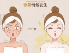 做激光后的注意事項有哪些呢？