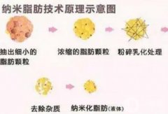 什么是納米脂肪填充？有哪些作用