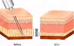水動力吸脂價格的影響因素有哪些？有什么副作用？