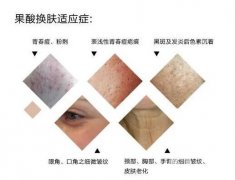 果酸換膚適合哪些人？不適合哪些人？