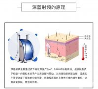 深藍射頻除皺有什么優(yōu)點？哪些因素決定深藍射頻除皺的價格