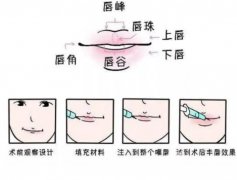 玻尿酸豐唇的優(yōu)點是什么，果如何？
