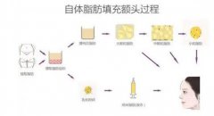 自體脂肪填充后的風(fēng)險(xiǎn)主要有哪些？