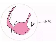 副乳切除后會(huì)復(fù)發(fā)嗎？副乳切除術(shù)有什么風(fēng)險(xiǎn)？