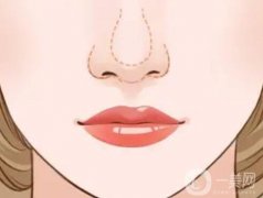 鼻頭縮小有哪些優(yōu)勢？會反彈嗎
