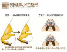 玻尿酸可以注射鼻小柱嗎？鼻小柱延長(zhǎng)有哪些常用方法