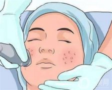 彩光嫩膚可以去除痘印嗎？如何護(hù)理？