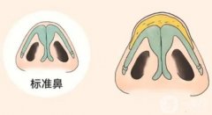 鼻頭縮小手術(shù)的優(yōu)點(diǎn)和缺點(diǎn)是什么？