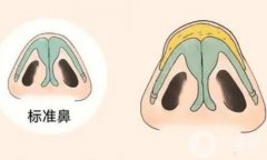 鼻小柱在哪里？延長鼻小柱的方法有哪些？