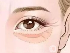 眼袋去除手術(shù)后會不會留下疤痕？手術(shù)痛不痛？