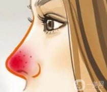 引起酒渣鼻的原因是什么？需要多少錢？