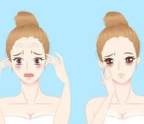 填充法令紋可以用哪些玻尿酸？