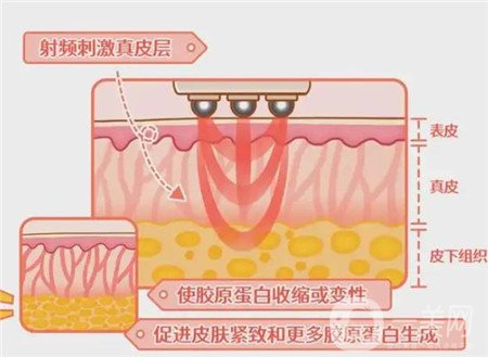 熱瑪吉電波拉皮*果怎么樣？維持多久？