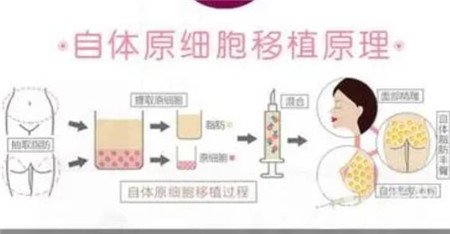 臉部脂肪填充后遺癥有哪些 臉部脂肪填充后臉會(huì)僵硬嗎