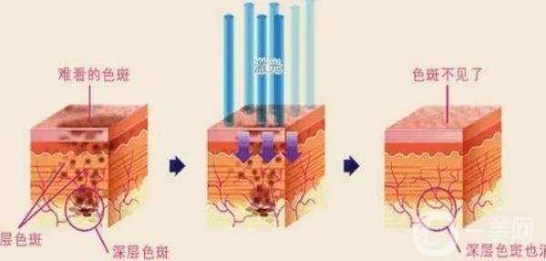 手術(shù)祛痣價格