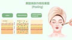 果酸換膚有哪些術前準備？術后如何護理？