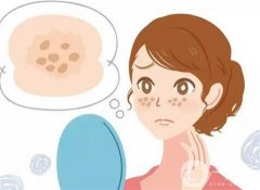 容易導(dǎo)致毀容的祛斑方法？這幾個(gè)一定要謹(jǐn)慎
