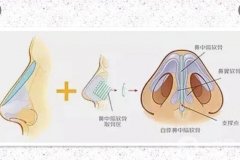 玻尿酸可以注射矯正鼻小柱嗎？鼻小柱在哪里？