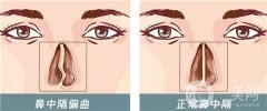 鼻中隔偏曲的危害是什么？手術(shù)的風(fēng)險(xiǎn)有哪些