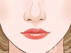 鼻頭縮小的優(yōu)勢有哪些？會反彈嗎