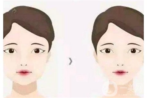 上海光纖溶脂瘦臉一共多少錢