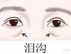 填充淚溝嗎?有風(fēng)險嗎?什么會影響價格