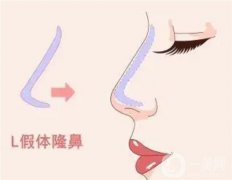 怎么防止L型假體穿透鼻尖？鼻假體取出后會增生嗎？