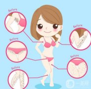 激光脫毛多少錢(qián)？禁忌人群分別有哪些？