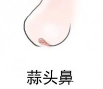 怎么矯正大蒜鼻？如何不手術(shù)改良大蒜鼻？