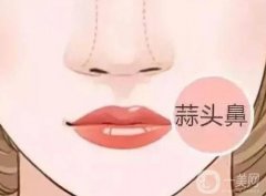 大蒜鼻整形有后遺癥嗎？恢復自然需要多長時間？