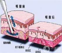 抽脂對身體會產(chǎn)生什么影響嗎？