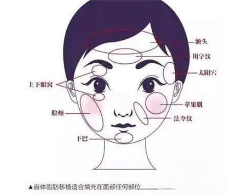 自體脂肪填充蘋果肌幾天可化妝?