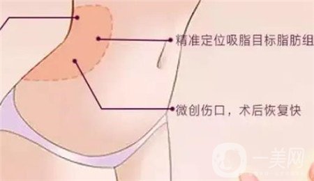 全身吸脂手術(shù)價格？馮斌做全身吸脂大概多少錢？