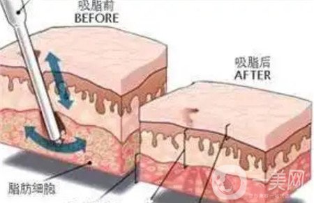 全身吸脂手術(shù)價格？馮斌做全身吸脂大概多少錢？