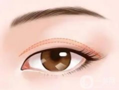 雙眼皮恢復(fù)自然需要多久？術(shù)后如何護(hù)理？