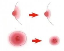 乳暈縮小術(shù)的方法？對(duì)母乳喂養(yǎng)有影響嗎？
