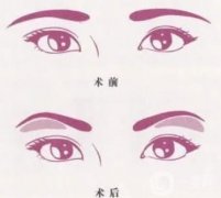 切眉后眼睛變形了怎么辦？浮腫怎么辦？
