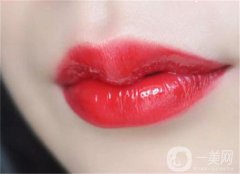 注射玻尿酸豐唇有哪些優(yōu)點(diǎn)？