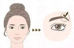 什么是切眉術(shù)？可以去除魚尾紋嗎