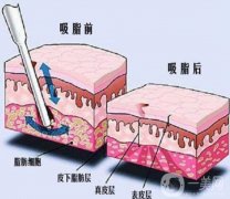 電子吸脂術(shù)有什么特點？有哪些適應癥？