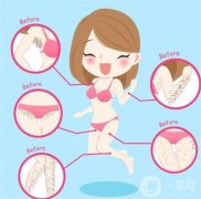 超冰點脫毛的副作用有哪些？
