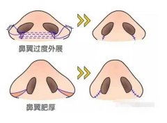 鼻翼內(nèi)切的切口在哪里？原理是什么？