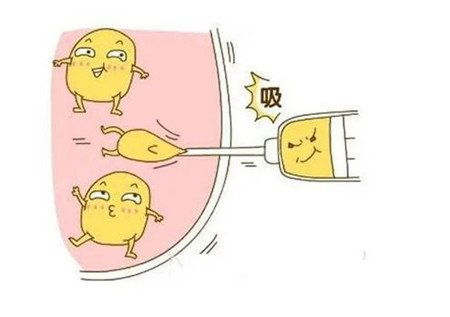 環(huán)形抽脂