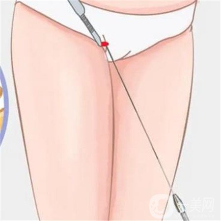 環(huán)形抽脂