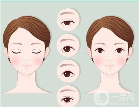 杭州格萊美醫(yī)院做雙眼皮咋樣?案例價格表公開