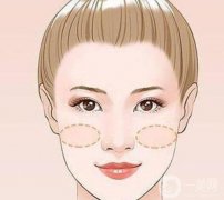 蘋果肌凹陷怎么處理？蘋果肌在哪里？